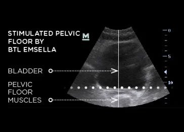 After EMSELLA Pelvic Floor