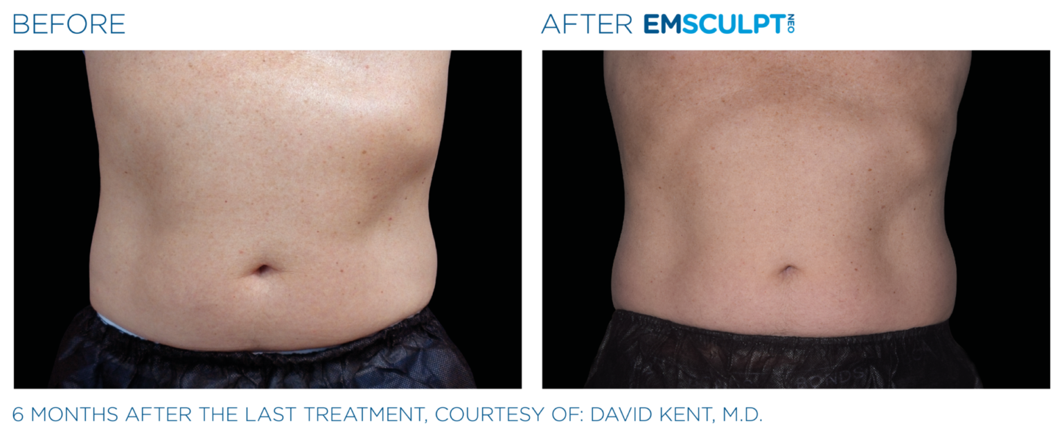 Body Sculpting emsculpt neo cja aesthetics southampton body contouring results 2 1536x629