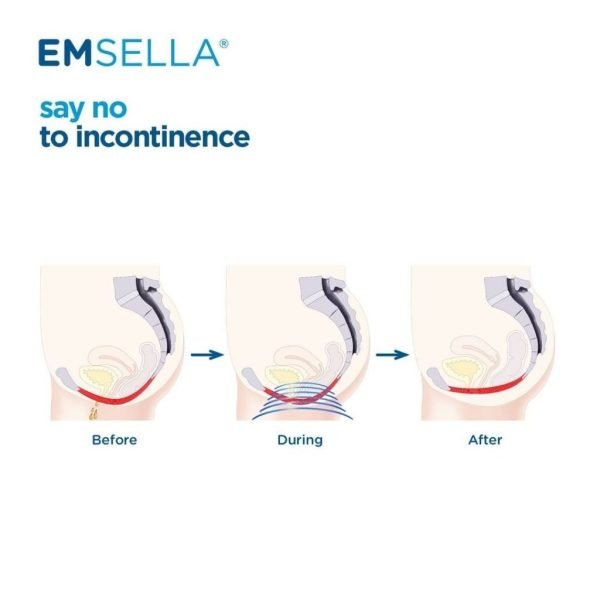 emsella urinary incontinence treatments are now offered in ny