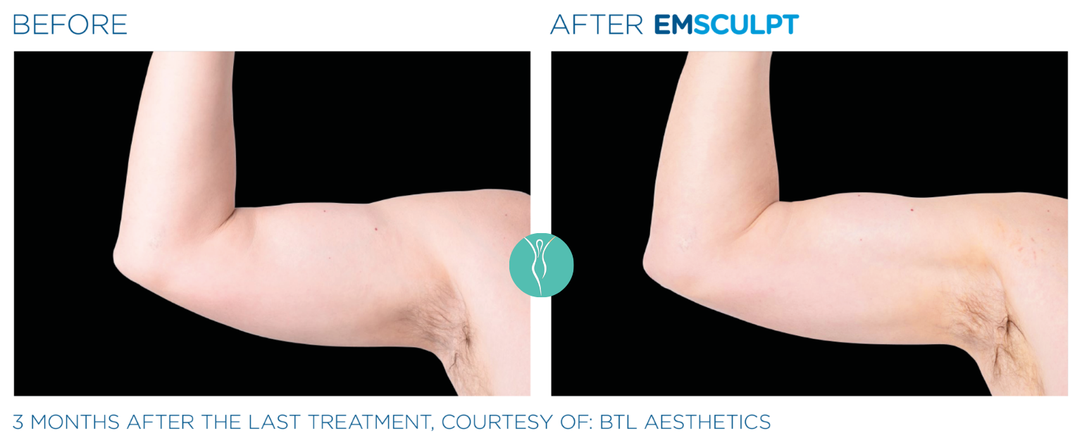 Body Sculpting emsculpt neo body sculpting before and after (1)