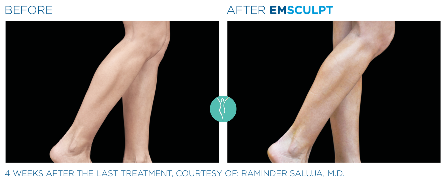Body Sculpting emsculpt neo body sculpting before and after (2)
