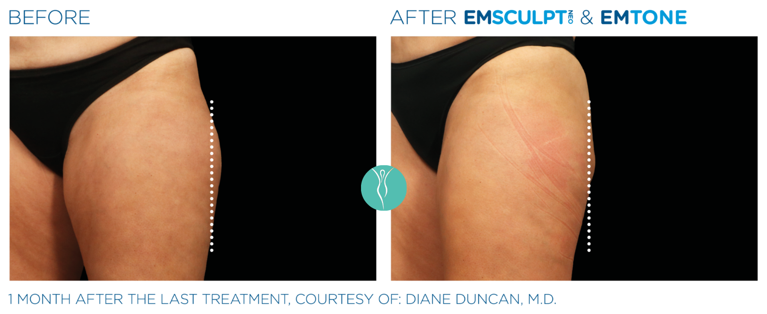 Body Sculpting emsculpt neo body sculpting before and after (3)