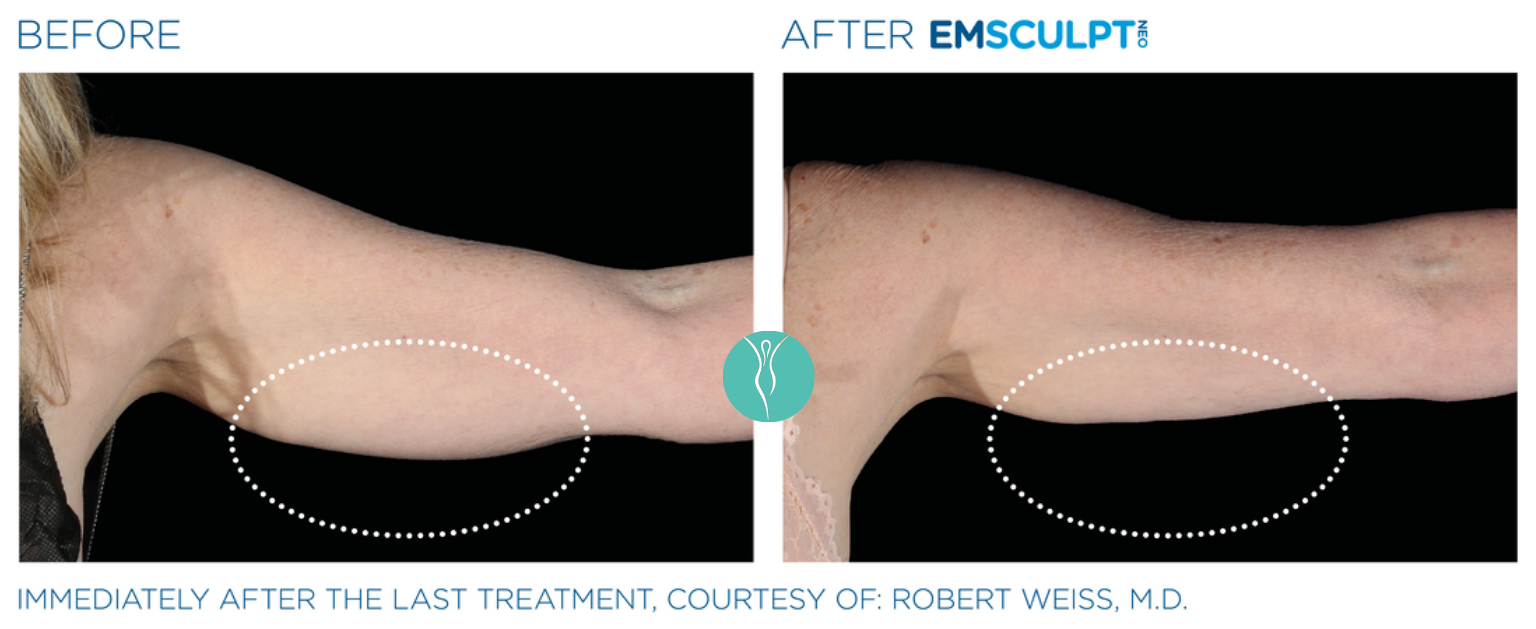 Body Sculpting emsculpt neo body sculpting before and after (4)