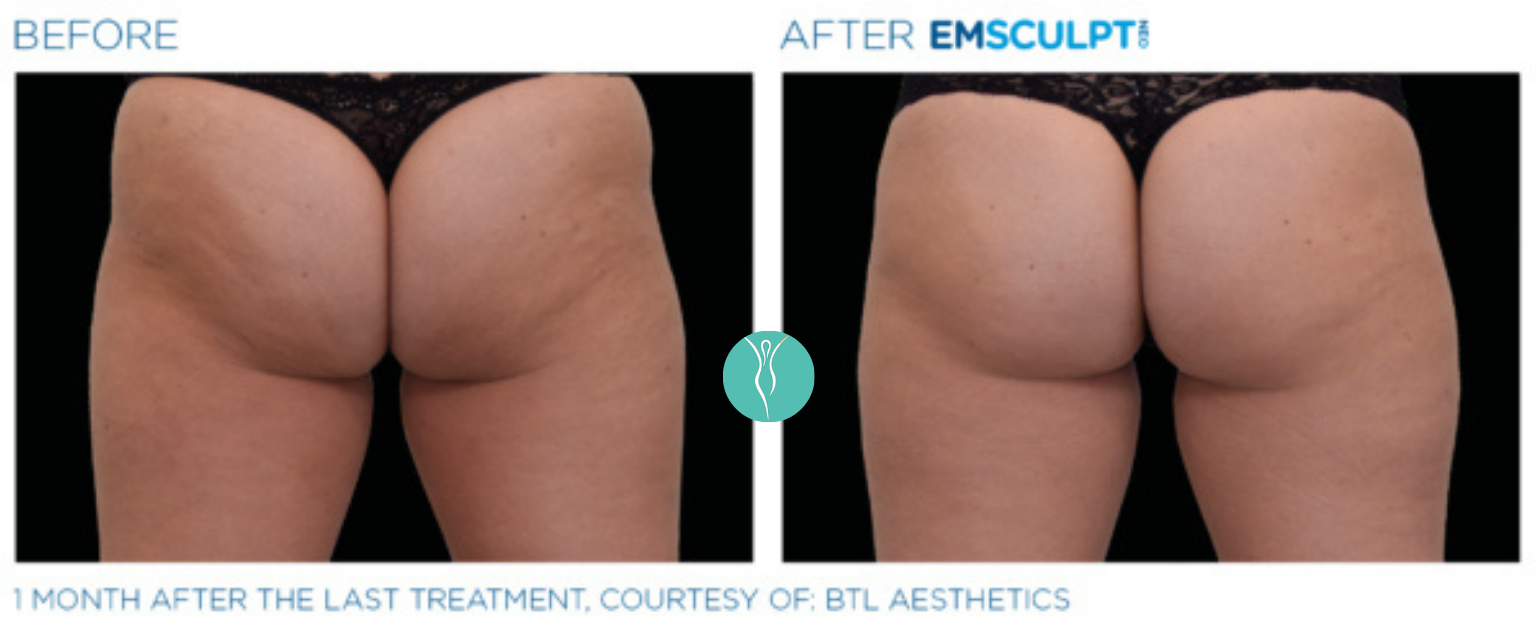 Body Sculpting emsculpt neo body sculpting before and after (5)