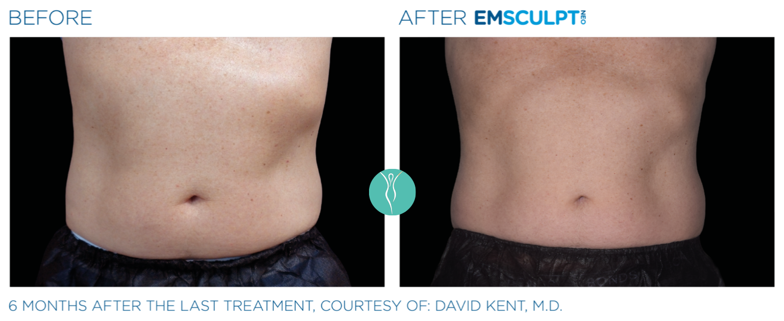 Body Sculpting emsculpt neo body sculpting before and after (6)